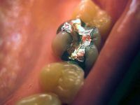 Tooth with dental amalgam filling