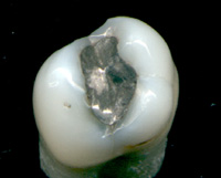 Tooth with dental amalgam filling