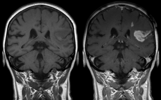Effect of contrast agent on images: Defect of the blood–brain barrier after stroke shown in MRI