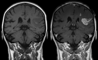 Effect of contrast agent on images: Defect of the bloodbrain barrier after stroke shown in MRI