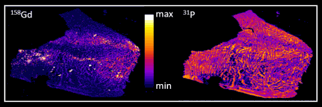 quantitative distribution maps for gadolinium and phosphorus of a human autopsy brain thin section investigated by LA-ICP-MS